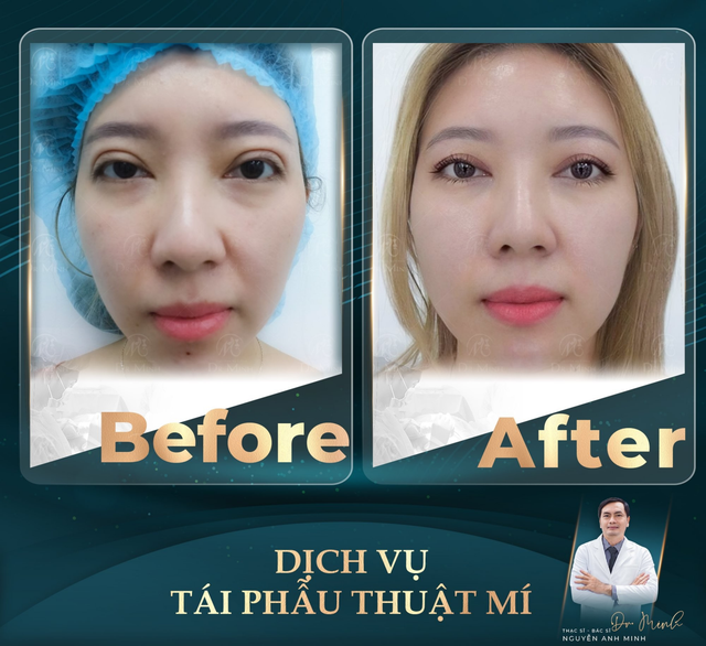 Bác sĩ phẫu thuật mí được nhiều chị em tin tưởng lựa chọn- Ảnh 1.