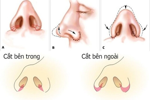 5 yếu tố giúp phân biệt cuộn cánh mũi và cắt cánh mũi - Ảnh 2.