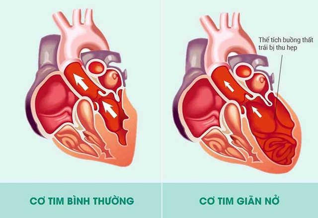 Khó thở, ho khan, đau ngực,… thận trọng với bệnh cơ tim giãn - Ảnh 1.