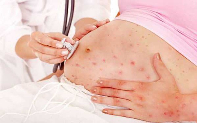 Virus Marburg cực nguy hiểm với phụ nữ mang thai, một số lưu ý để kiểm soát bệnh - Ảnh 3.