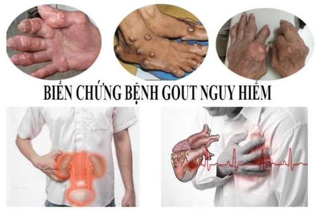 Bệnh gout có những biến chứng nguy hiểm mà nhiều người chưa biết - Ảnh 2.