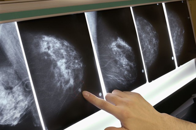 Nghiên cứu mới: Một số bệnh nhân ung thư vú từ 65 tuổi trở lên có thể không cần xạ trị - Ảnh 2.