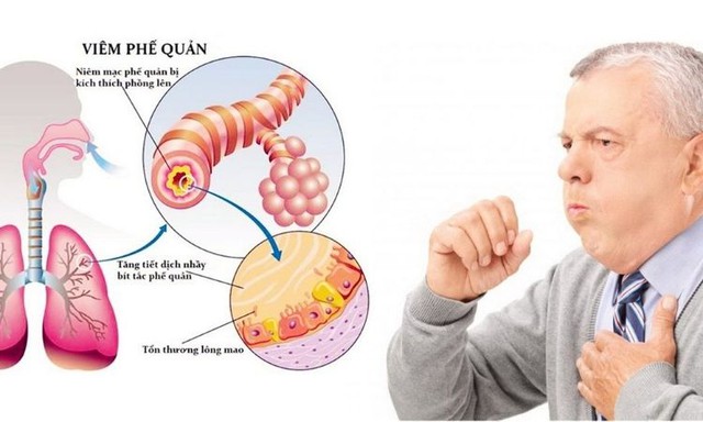 Một số bệnh liên quan đến viêm đường hô hấp dưới - Ảnh 4.