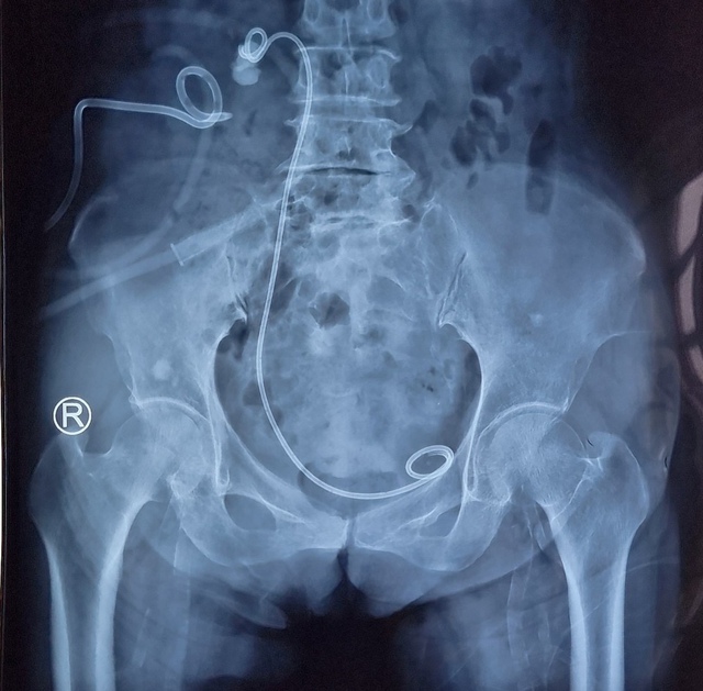 Phẫu thuật nội soi 1 lỗ (mini PCNL) ở  tư thế   nằm ngửa cho bệnh nhân bị sót sỏi, thận mủ và áp xe quanh thận - Ảnh 1.