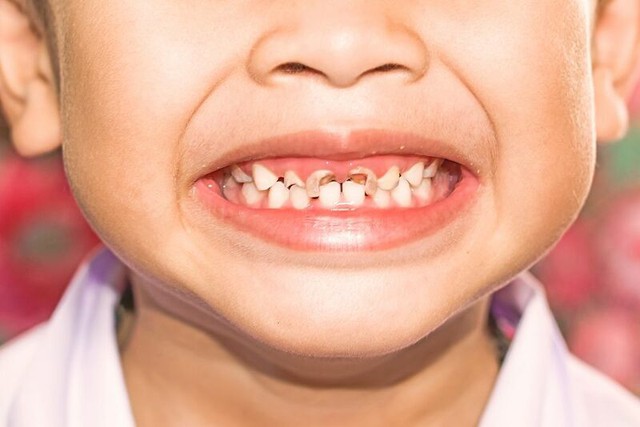 Cần làm gì để phòng bệnh sâu răng ở trẻ em? - Ảnh 2.