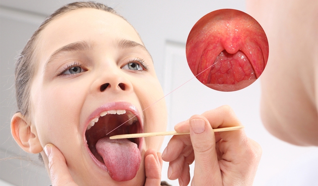 Ho sốt, đau rát ở vùng cổ họng… thận trọng với viêm họng do liên cầu khuẩn - Ảnh 4.