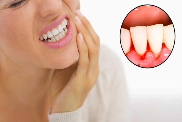 Viêm quanh răng mạn tính do đâu và chữa thế nào? - Ảnh 2.