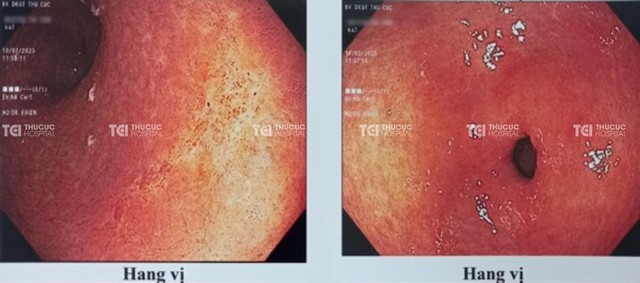 K dạ dày “chớm nở” nhưng đã di căn và giá trị của tầm soát - Ảnh 1.