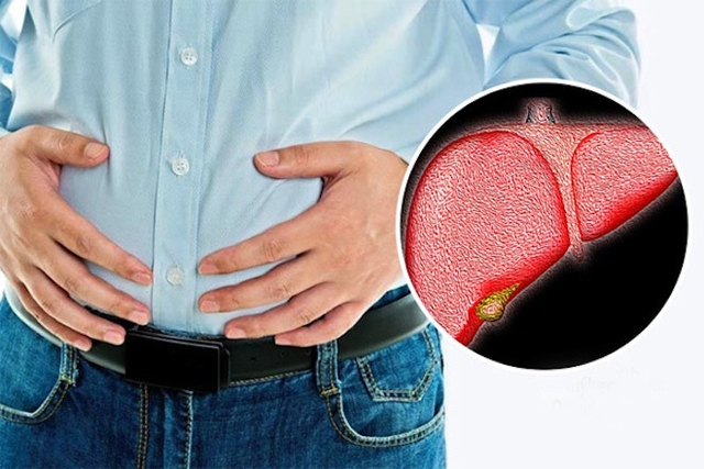 Gan nhiễm mỡ là bệnh gây ra bởi sự tích tụ quá nhiều chất béo trong tế bào gan.