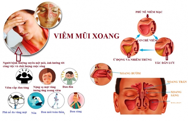 Người mắc bệnh viêm xoang khi thời tiết giao mùa, chuyển mùa sẽ phải gặp những khó chịu.