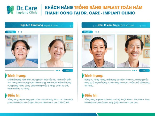 Nha khoa chuyên sâu trồng răng Implant tại TP.HCM - Ảnh 3.