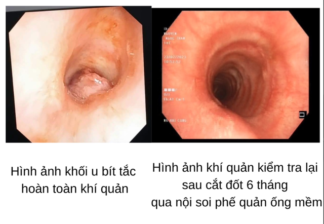 Cứu sống cô gái 17 tuổi mang khối u khí quản hiếm gặp  - Ảnh 1.