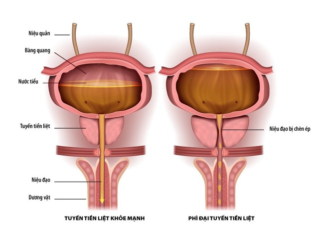 Tiểu khó, tiểu đêm nhiều do phì đại tuyến tiền liệt, phải làm sao? - Ảnh 1.