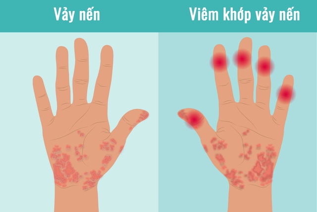 Bị viêm khớp vảy nến nên làm gì? - Ảnh 1.