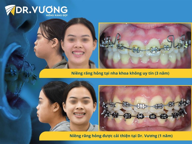 Thế nào là một ca niềng răng thành công? - Ảnh 3.