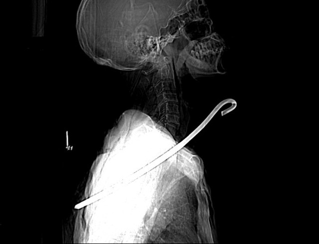 Người đàn ông bị cây sắt dài 30cm đâm xuyên từ cổ qua phổi - Ảnh 1.