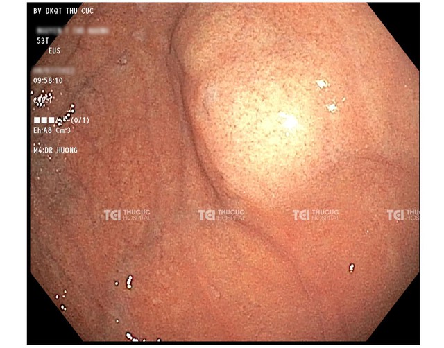 Khối u 3cm trong dạ dày bỗng nhiên &quot;biến mất&quot; - Ảnh 1.