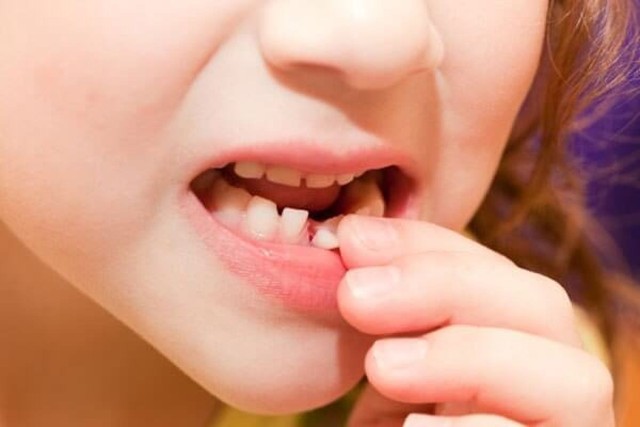 Chấn thương răng sữa ở trẻ xử trí thế nào? - Ảnh 4.