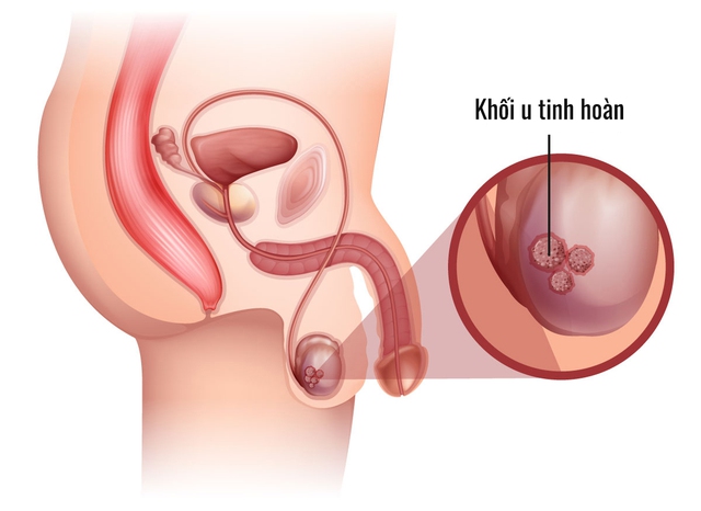 Ung thư tinh hoàn có chữa được không, triệu chứng cần biết - Ảnh 2.