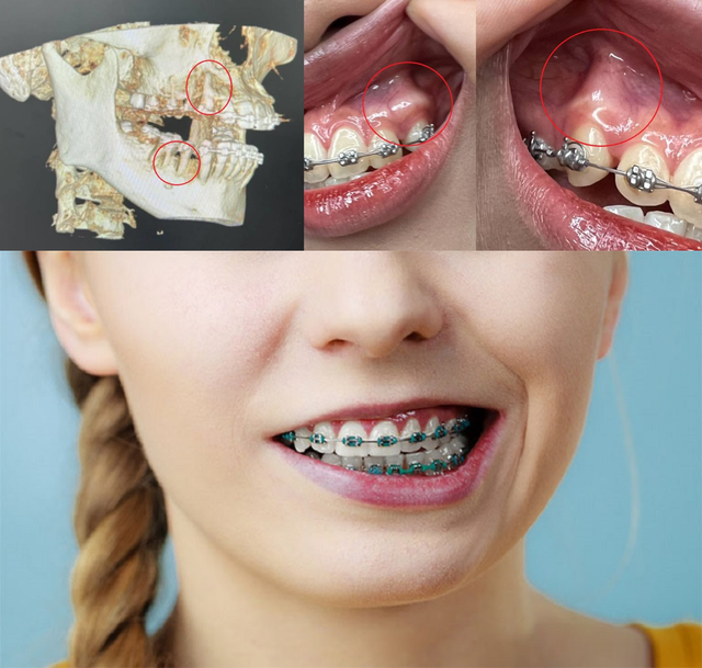"Răng chạy nhanh" trong quá trình niềng răng liệu có phải là dấu hiệu tốt? - Ảnh 2. "Răng chạy nhanh" trong quá trình niềng răng liệu có phải là dấu hiệu tốt? - Ảnh 2.