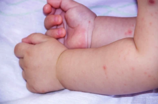 5 dấu hiệu cần cho trẻ mắc tay chân miệng nhập viện gấp - Ảnh 1.
