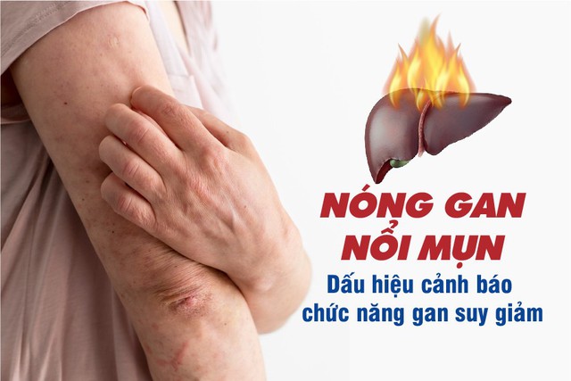 Nóng gan nổi mụn – Dấu hiệu cảnh báo chức năng gan suy giảm - Ảnh 1.