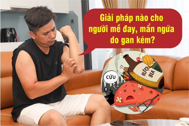 Giải pháp nào cho người bị mề đay, mẩn ngứa do gan kém? - Ảnh 1.