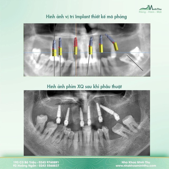 Tại sao cần dùng máng hướng dẫn phẫu thuật Implant trong các ca toàn hàm? - Ảnh 1.