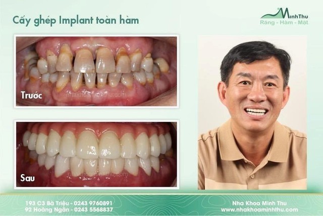 Tại sao cần dùng máng hướng dẫn phẫu thuật Implant trong các ca toàn hàm? - Ảnh 5.