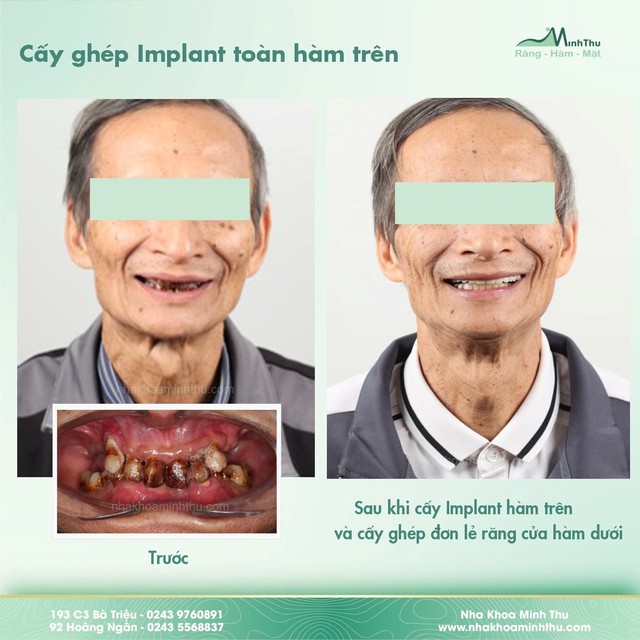 Tại sao cần dùng máng hướng dẫn phẫu thuật Implant trong các ca toàn hàm? - Ảnh 6.