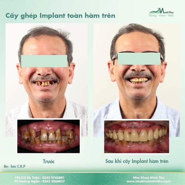 Tại sao cần dùng máng hướng dẫn phẫu thuật Implant trong các ca toàn hàm? - Ảnh 7.