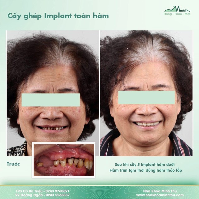 Tại sao cần dùng máng hướng dẫn phẫu thuật Implant trong các ca toàn hàm? - Ảnh 8.