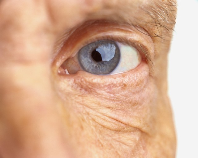 Cách nhận biết biến chứng mắt ở bệnh nhân đái tháo đường  - Ảnh 2.