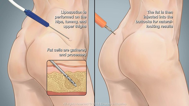 Tại sao bơm mỡ mông là thủ thuật thẩm mỹ nguy hiểm? - Ảnh 1.