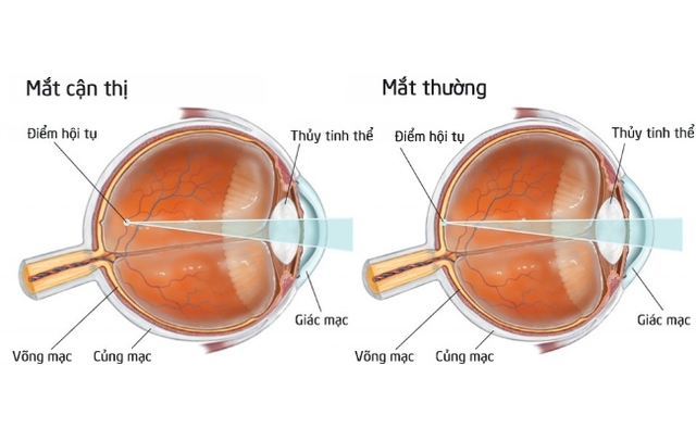 Những lưu ý quan trọng khi sử dụng kính áp tròng. - Ảnh 3.