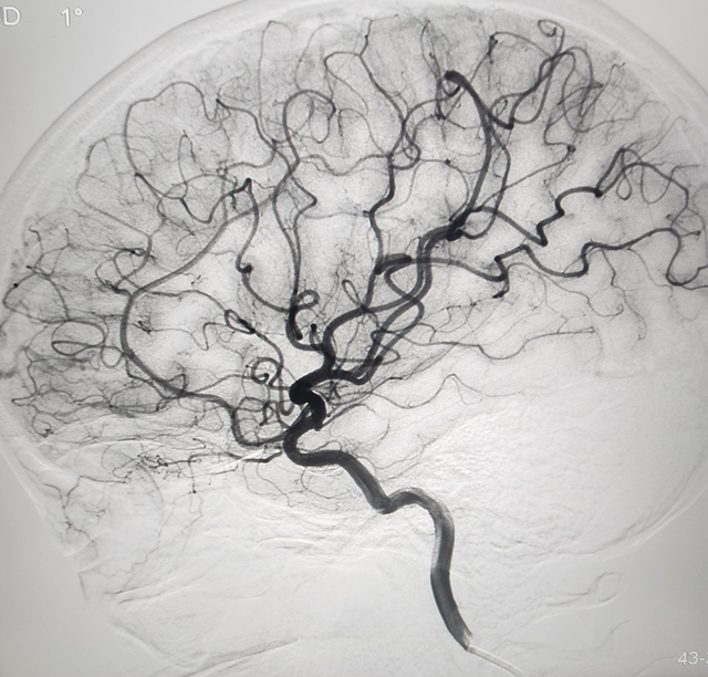 Điều trị phình mạch máu não bằng can thiệp nội mạch - Ảnh 2.