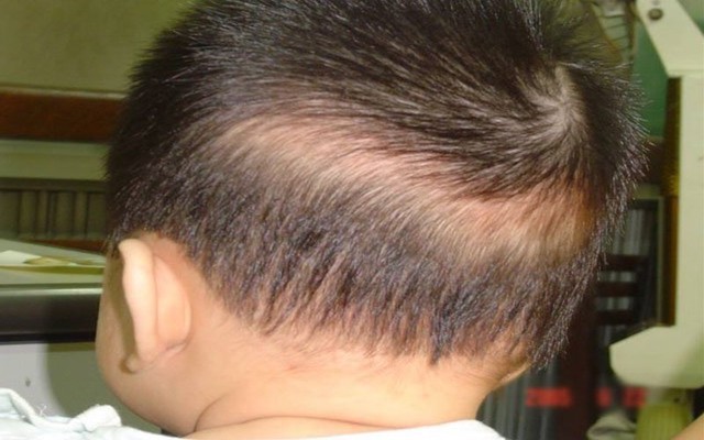 Trẻ nhỏ hay bị rụng tóc thành một vệt ở sau đầu, vùng chẩm nhìn như một vành khăn ôm lấy đầu của bé.