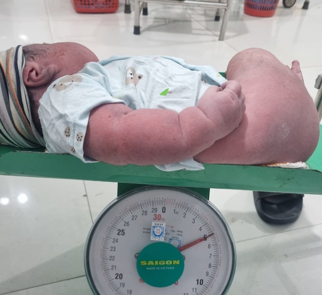 Hi hữu sản phụ sinh thường bé trai nặng 5kg ở trung tâm y tế huyện - Ảnh 1.