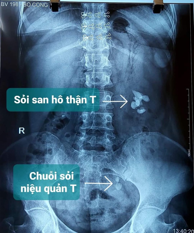 Sỏi thân: Nguyên nhân, dấu hiệu và cách điều trị - Ảnh 2.