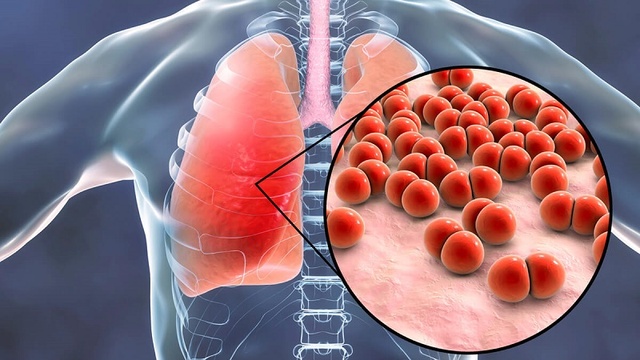 Nấm phổi: Nguyên nhân, dấu hiệu và cách phòng ngừa - Ảnh 1.