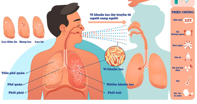 Nguồn lây bệnh lao cho người lành chủ yếu là người bệnh mắc lao phổi, đặc biệt là người bệnh có vi khuẩn tìm thấy được bằng xét nghiệm đờm soi kính trực tiếp.