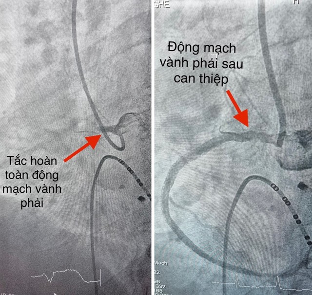 Mắc bệnh tim nhưng không điều trị dễ mất mạng - Ảnh 1.