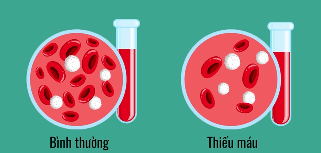 Thiếu máu: Nguyên nhân, dấu hiệu và cách điều trị - Ảnh 1.