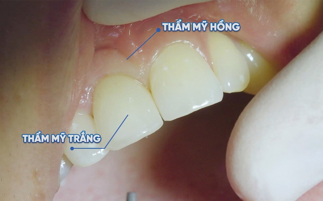Các yếu tố quyết định đến tính thẩm mỹ khi trồng răng implant - Ảnh 1.