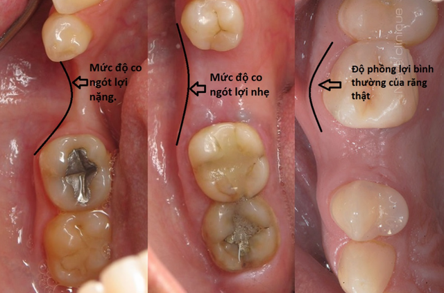 Các yếu tố quyết định đến tính thẩm mỹ khi trồng răng implant - Ảnh 2.