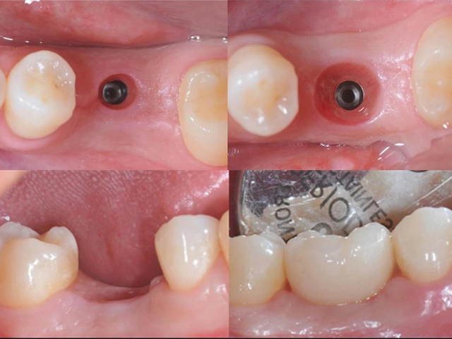 Các yếu tố quyết định đến tính thẩm mỹ khi trồng răng implant - Ảnh 4.