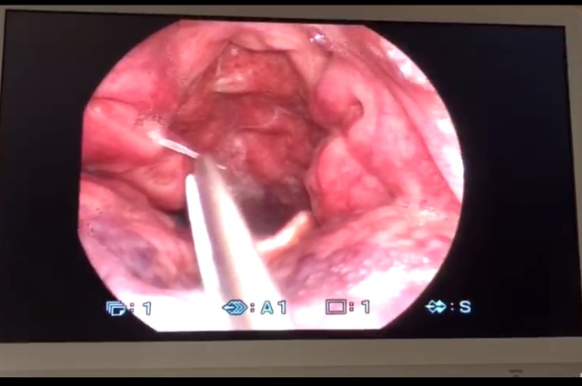 Hóc xương cá – nếu chữa mẹo không đúng cách sẽ gây hậu quả nghiêm trọng như nào? - Ảnh 1.