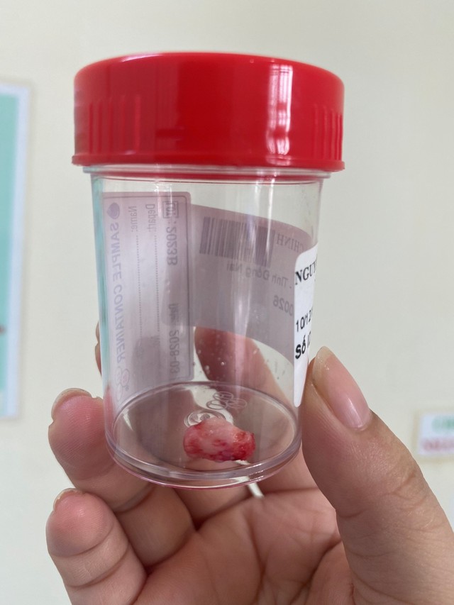 Chuyên khoa Tai mũi họng – Bệnh viện Hoàn Mỹ ITO Đồng Nai phẫu thuật thành công cho bệnh nhân có răng mọc lạc chỗ trong xoang sàng - Ảnh 2.