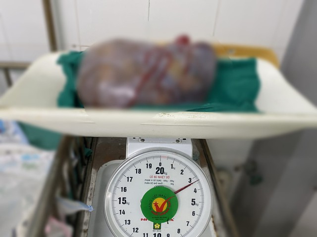 Bụng to bất thường, cụ bà 77 tuổi phát hiện có khối u ác buồng trứng nặng 3,3kg - Ảnh 1.