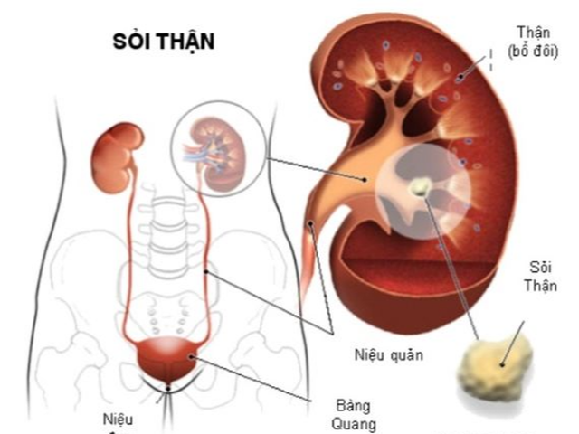 Cách dùng chanh phòng ngừa sỏi thận - Ảnh 5.